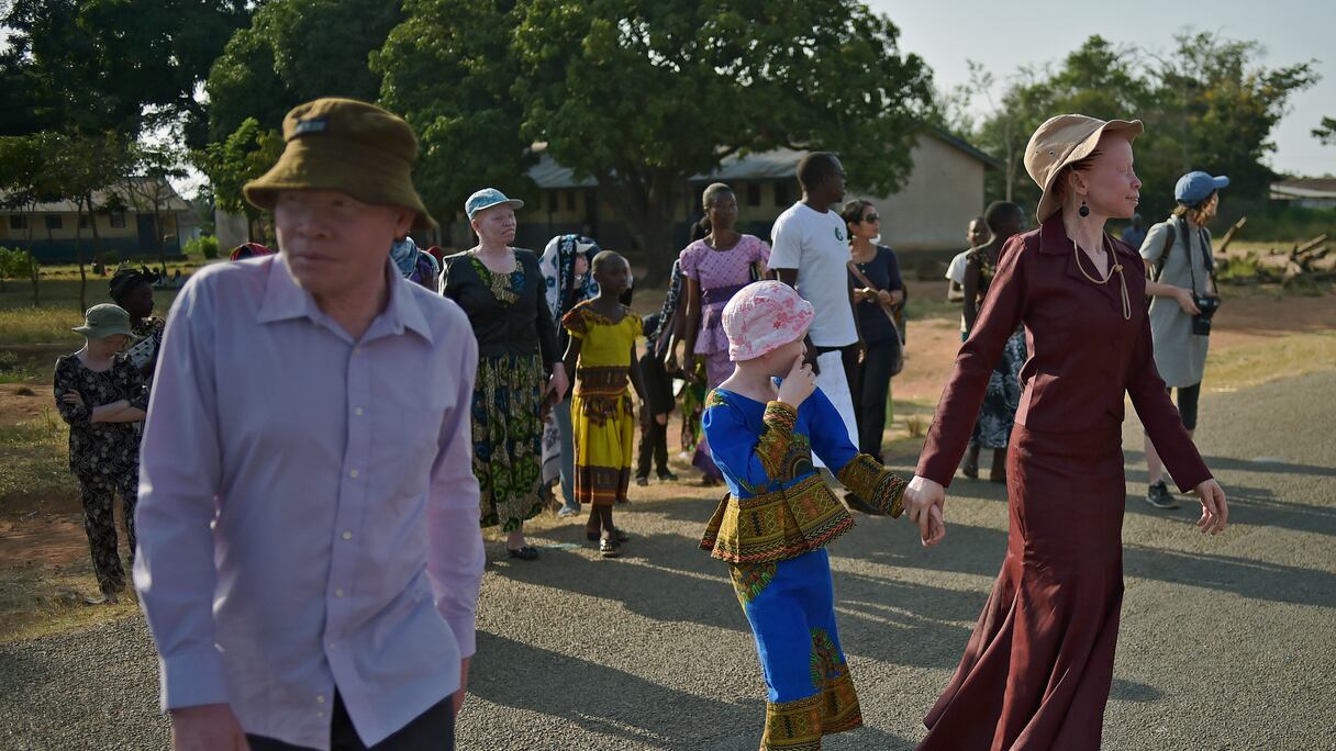 Albinos sur l'île d'Ukerewe lors de la journée internationale de sensibilisation à l'albinisme le 13 juin 2016. L'île d'Ukerewe abrite de nombreux albinos. Bon nombre des premiers albinos à vivre sur l'île y ont été emmenés et abandonnés par leurs familles lorsqu'ils étaient enfants ou ont fui la violence à laquelle ils avaient été confrontés sur le continent.