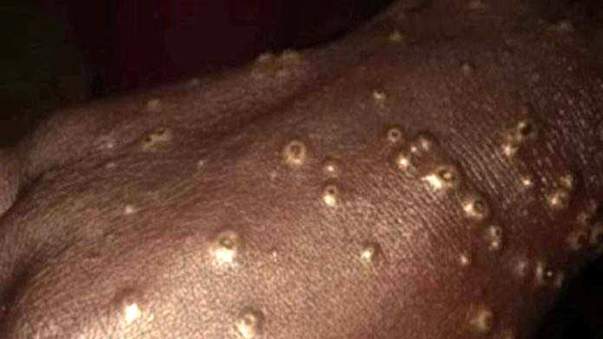 La maladie touche aussi bien les membres que les parties génitales externes.